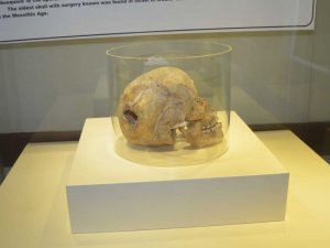 3 bin yıllık kafatasında ameliyat izi