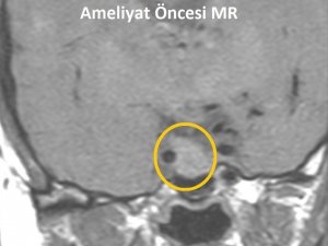 Hipofiz tümörü olan kadın başarılı bir ameliyatla tedavi edildi