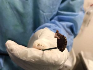 Öksürük şikayetiyle gitti, akciğerinden çekirdek çıktı