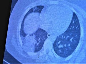 Koronaya yakalanan 15 yaş altı çocuklarda ciddi akciğer tutulumları