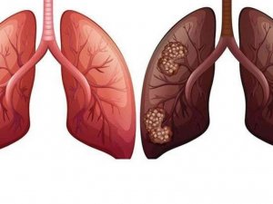 Akciğer kanserine yüzde 90 tütün kullanımı neden oluyor