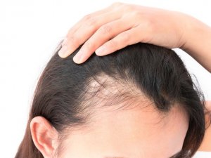 Saçınız günde 100 tel dökülüyorsa dikkat