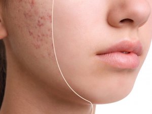 Sivilce Neden Oluşur?