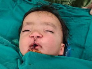 Yarık damak ve dudaklı bebeğe "Türk lalesi" ameliyatı