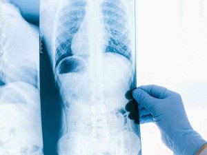 Akciğer kanserinin 10 belirtisi