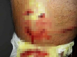 Yürüyüş yaparken sokak köpeklerinin saldırısına uğradı