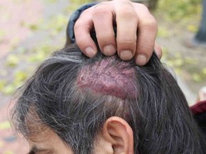 Başında oluşan kistten muzdarip olan hastaya 12 yıldır teşhis konulamadı