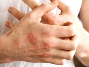 El dezenfektanları egzamaya davetiye çıkarıyor