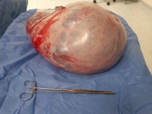 Karnından 9 kilo tümör çıktı