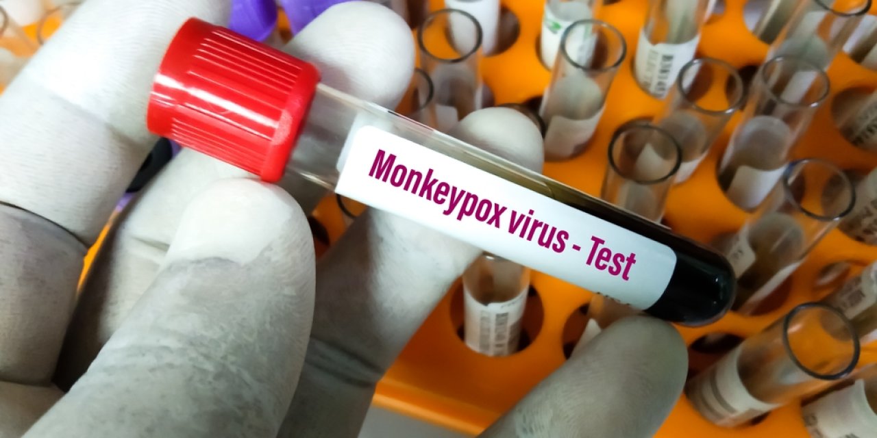 Maymun çiçeği virüsünde bu belirtilere dikkat!