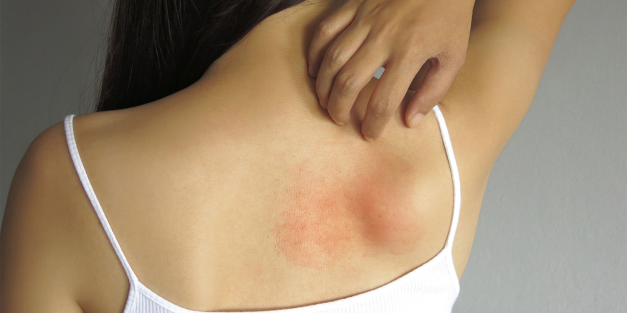 Alerjinizi iyi tanıyın!