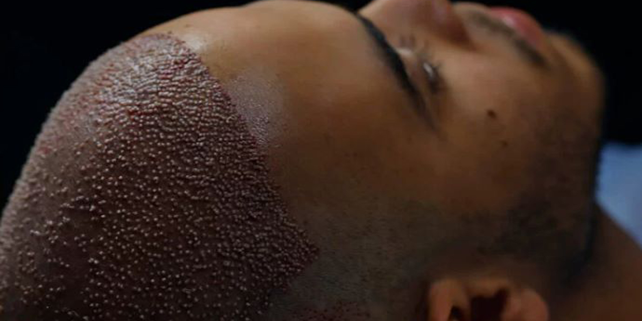 İstanbul saç ekimi uygulaması