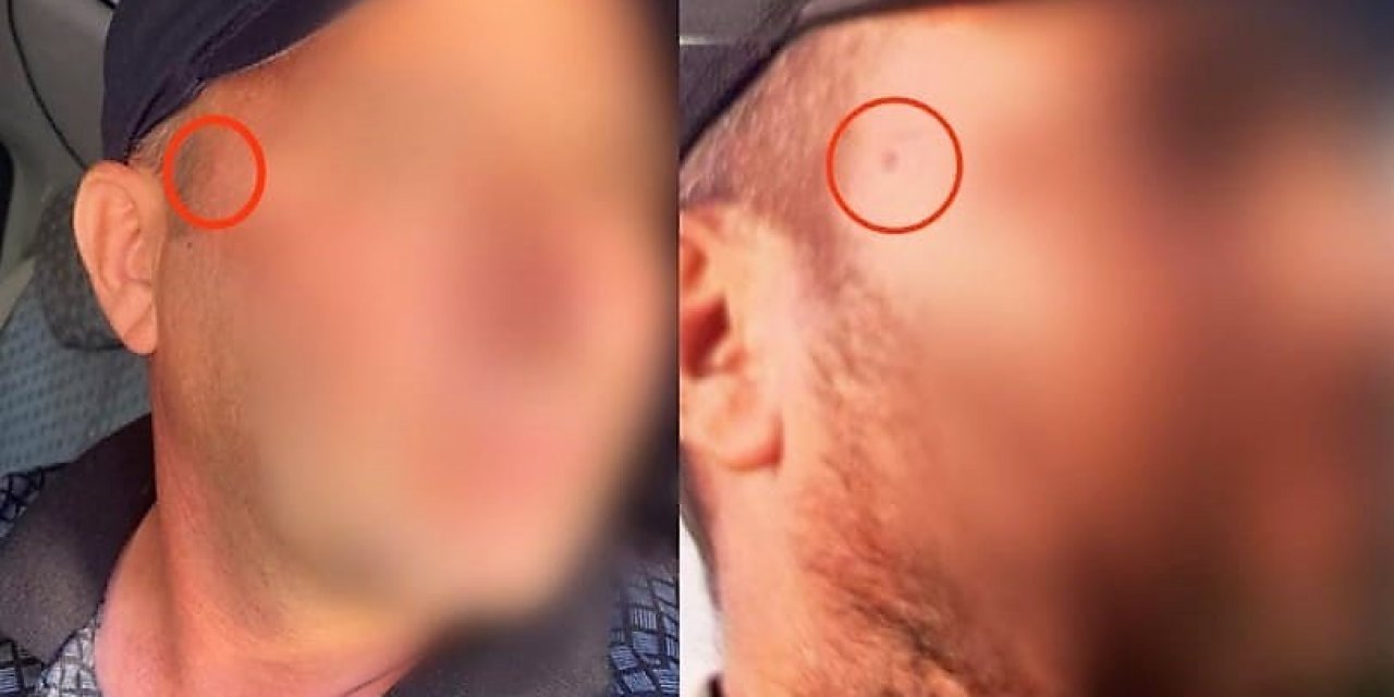 Jandarma korkusundan yüzündeki beni aldırdı