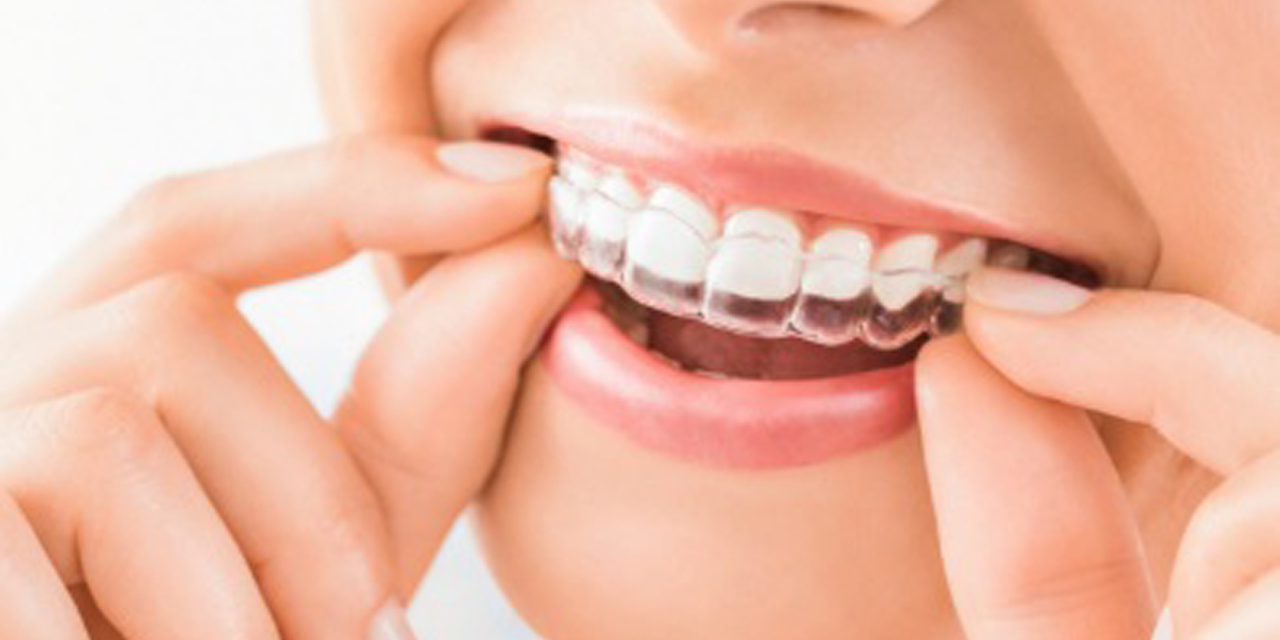 Invısalıgn tedavisinde süreç nasıl işler?