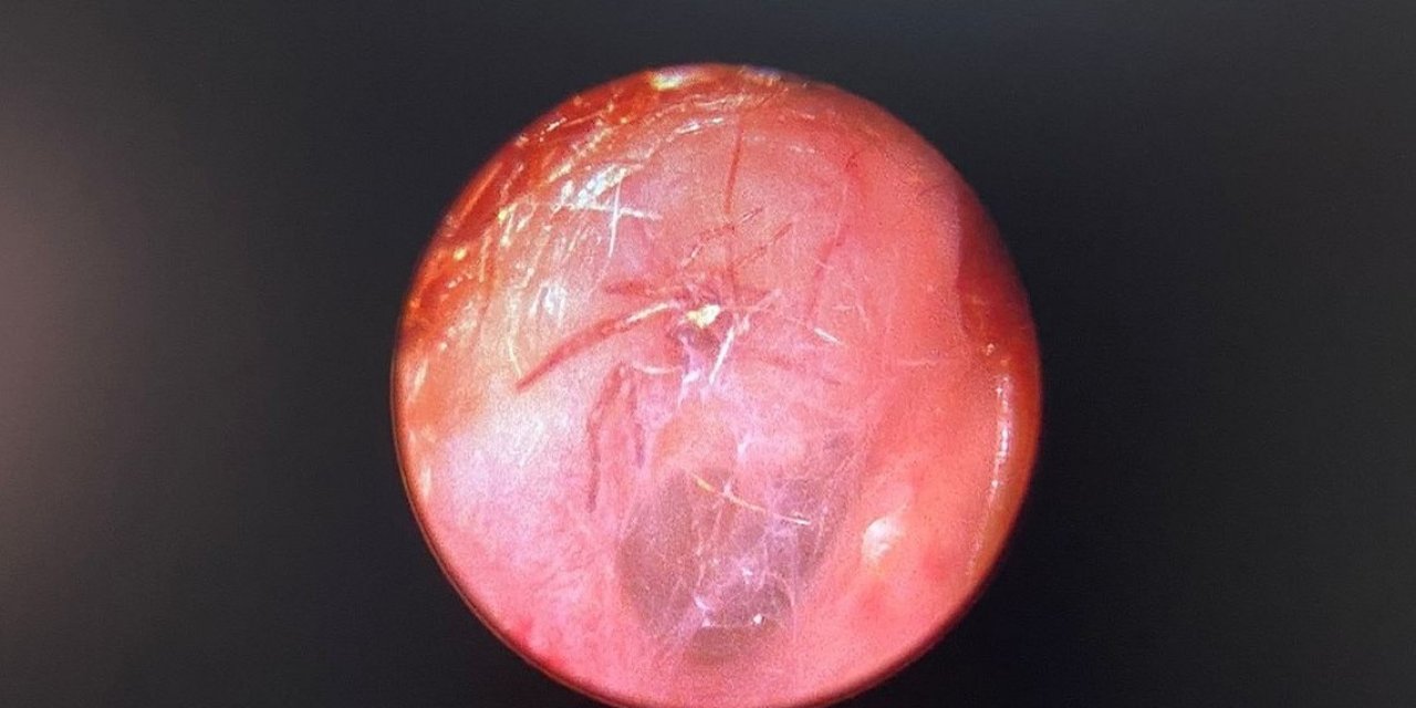 Kulağından canlı örümcek çıktı