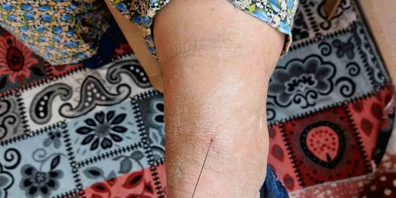 Ayak topuğundan 37 santim tel çıktı