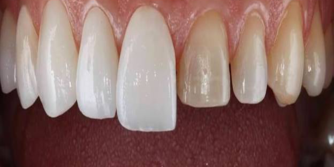 Zirkonyum kaplama ile estetik ve dayanıklı dişler