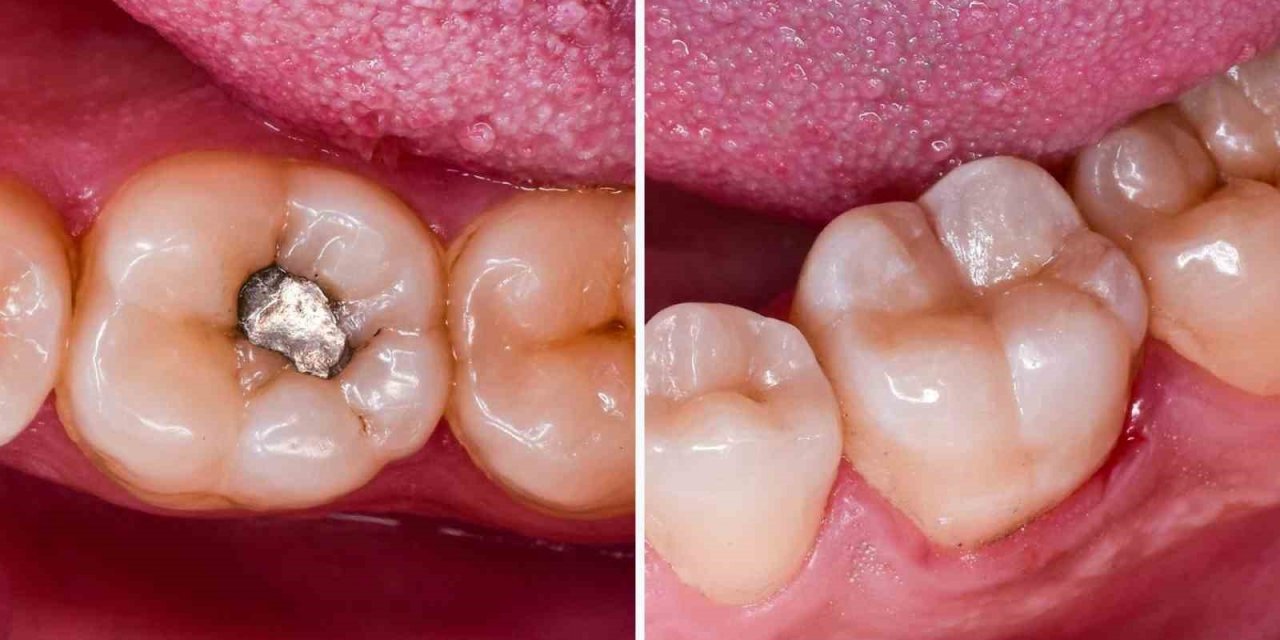 Gümüş dolgu olarak bilinen amalgam dolgularda cıva tehlikesi