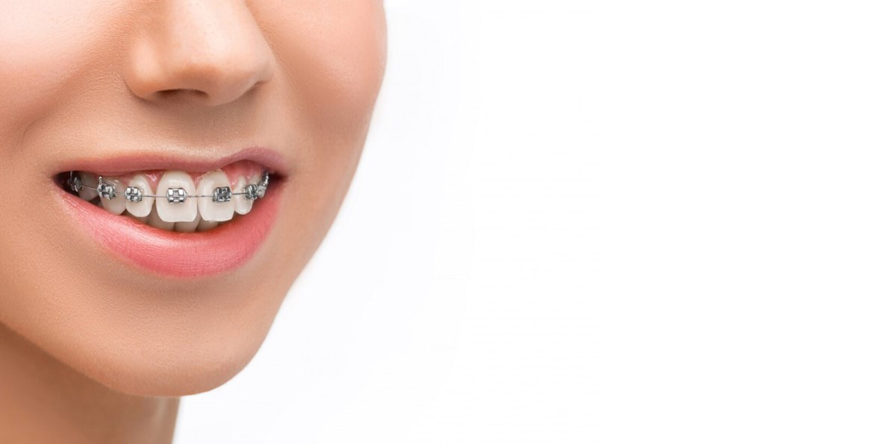 Diş teli tedavisi ile kalıcı bir çözüm