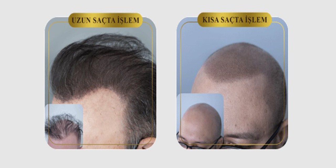 Saç simülasyonu nedir? Semih Deniz ile öğrenin