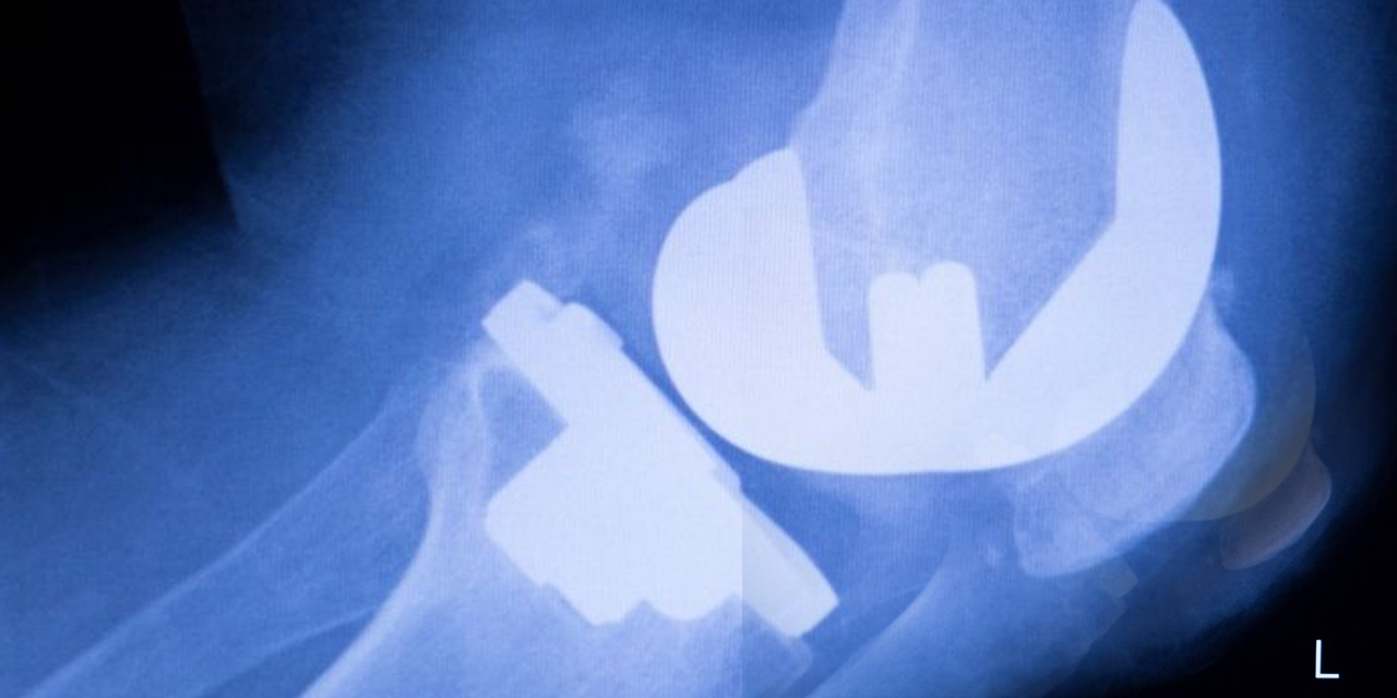 Eklem sağlığı: Tedavi yöntemleri ve ameliyatlar