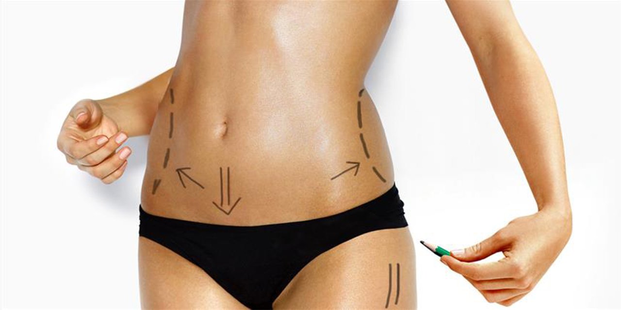 Karın germe ameliyatı (Abdominoplasti) nedir?