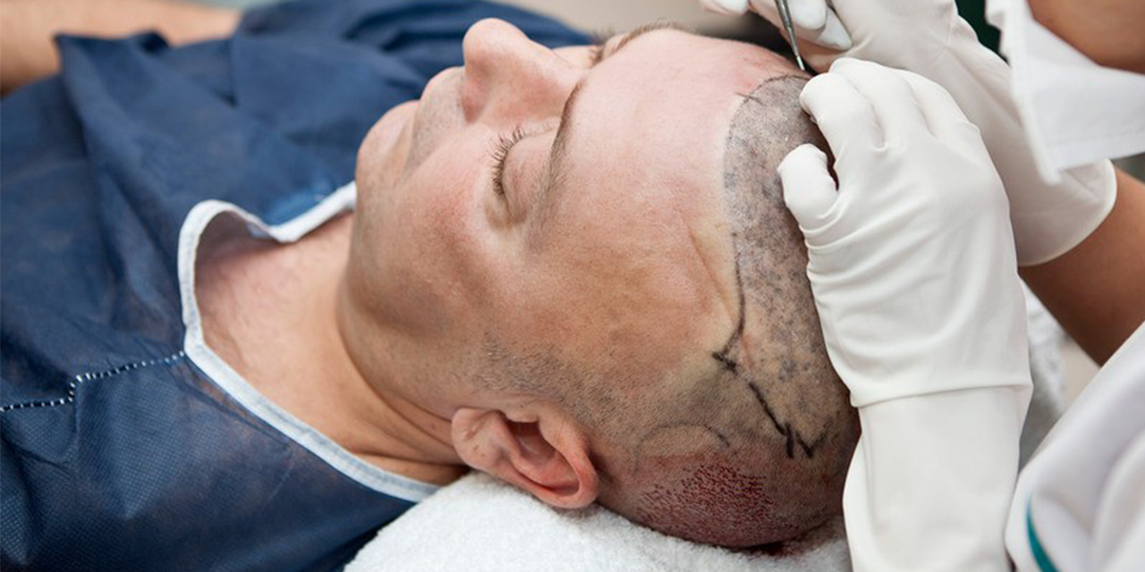 Saç ekimi hakkında bilmeniz gereken her şey