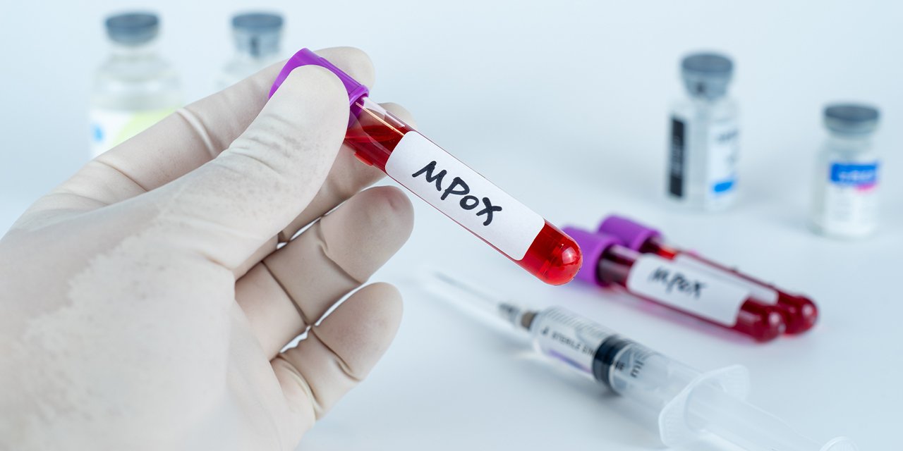 Maymun Çiçeği virüsü alarmı!