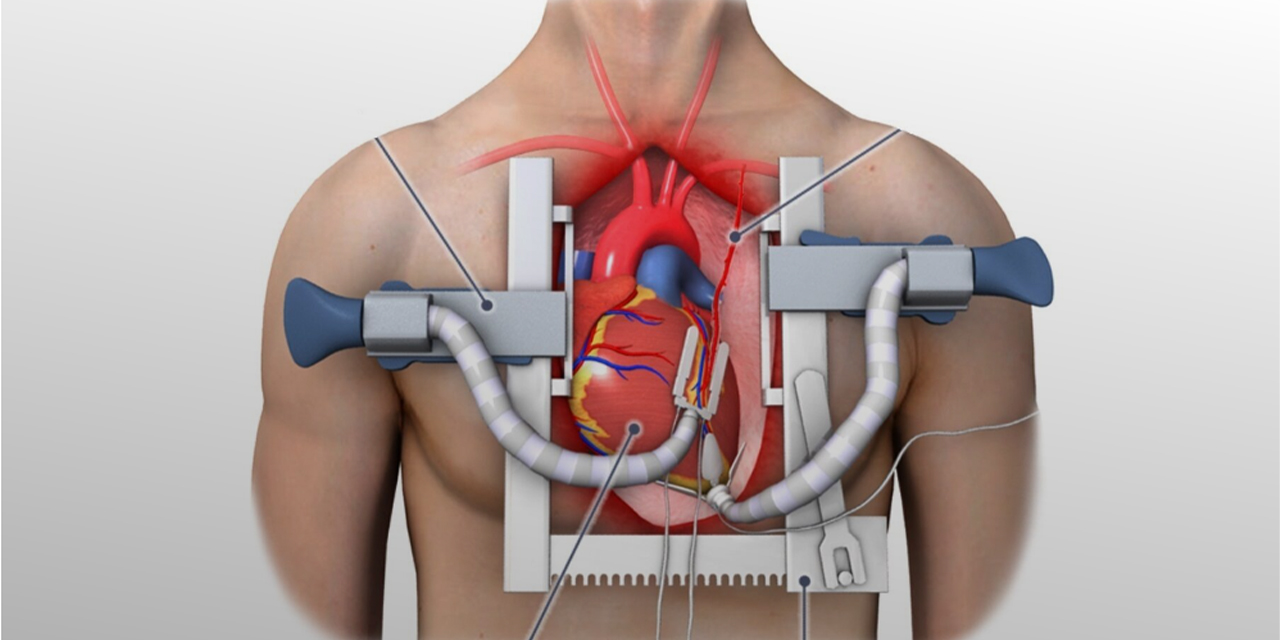 Bypass ameliyatı nedir?