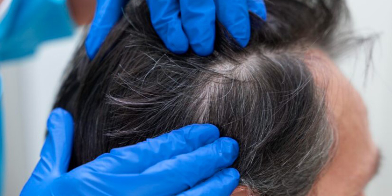 Bolu’da saç ekimi ile doğal ve kalıcı sonuçlar alın