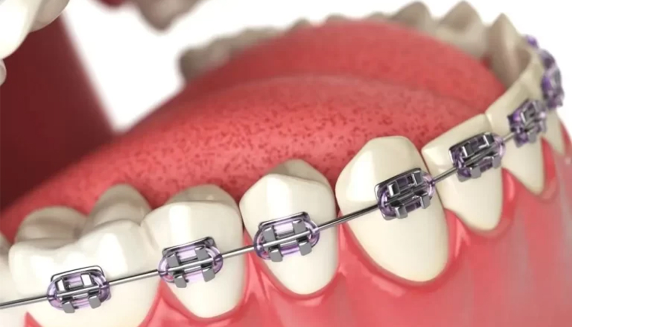 Ortodonti ile diş tellerinin işlevi ve estetik yaklaşımlar