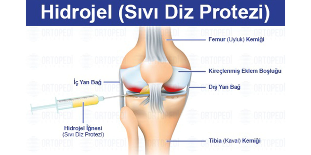 Sıvı Diz Protezi (Hidrojel) Hakkında Bilmeniz Gereken Her Şey