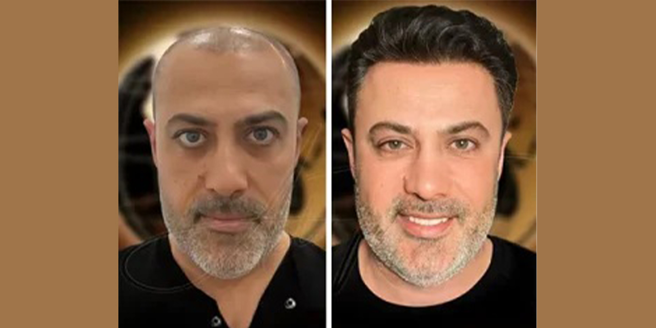 Saç ekimi gerçekte ne kadar kalıcı?