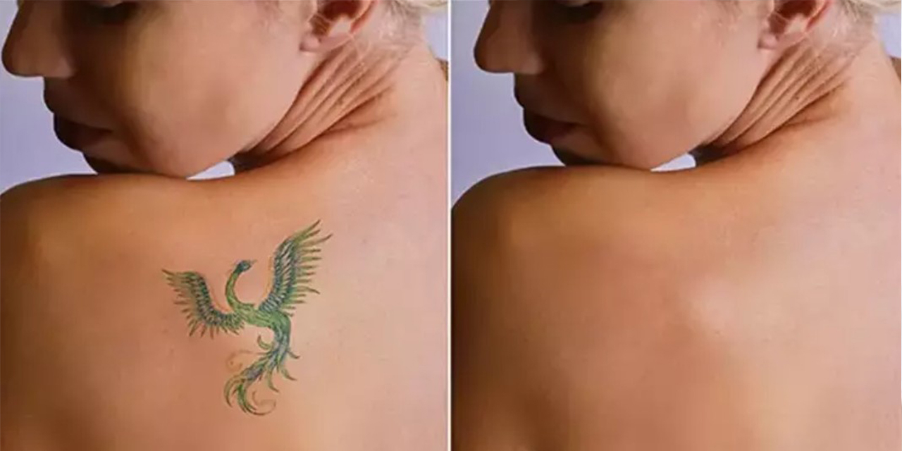 Eski dövmeden tamamen kurtulmak kaç seans sürer ve hangi lazerler daha hızlı sonuç verir?