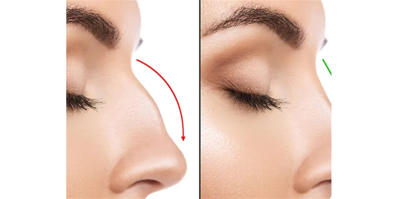 Burun estetiği ile yalnızca görünüm değil, yüz dengesi nasıl iyileştirilir?