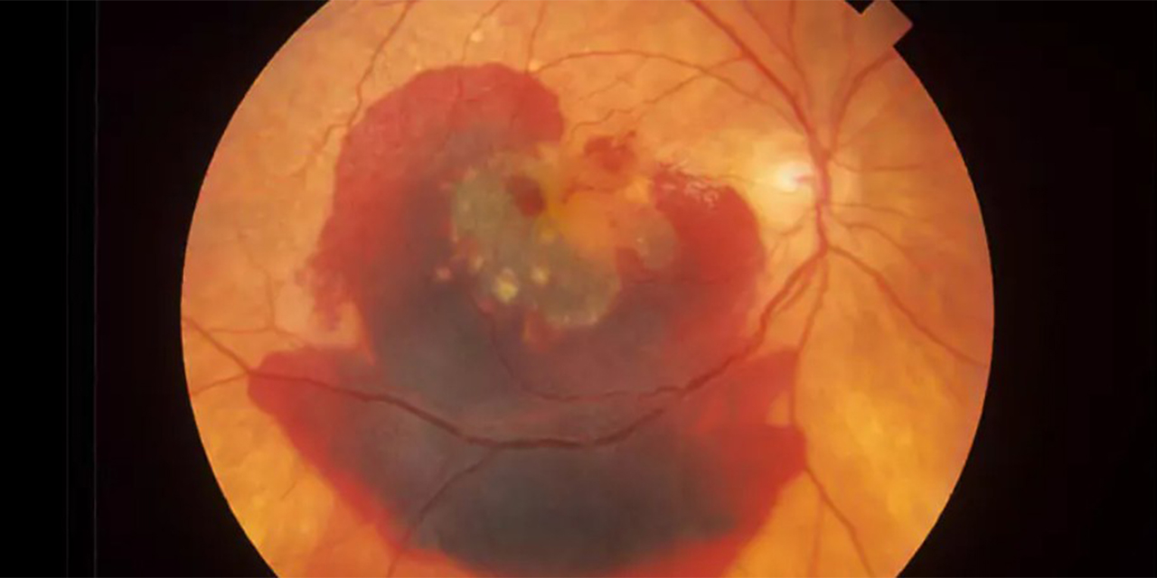 Sarı nokta hastalığı (yaşa bağlı makula dejenerasyonu) görüşü nasıl etkiler?