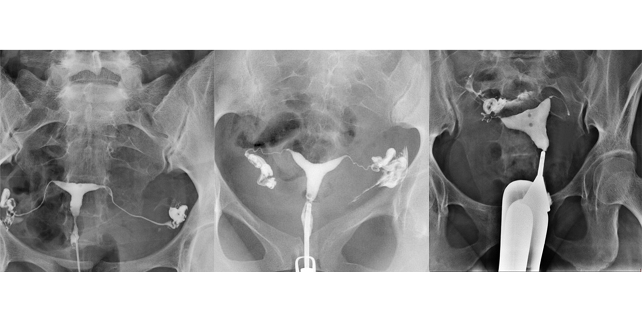 Rahim filmi sırasında tüplerimin açık olup olmadığını nasıl anlarım?