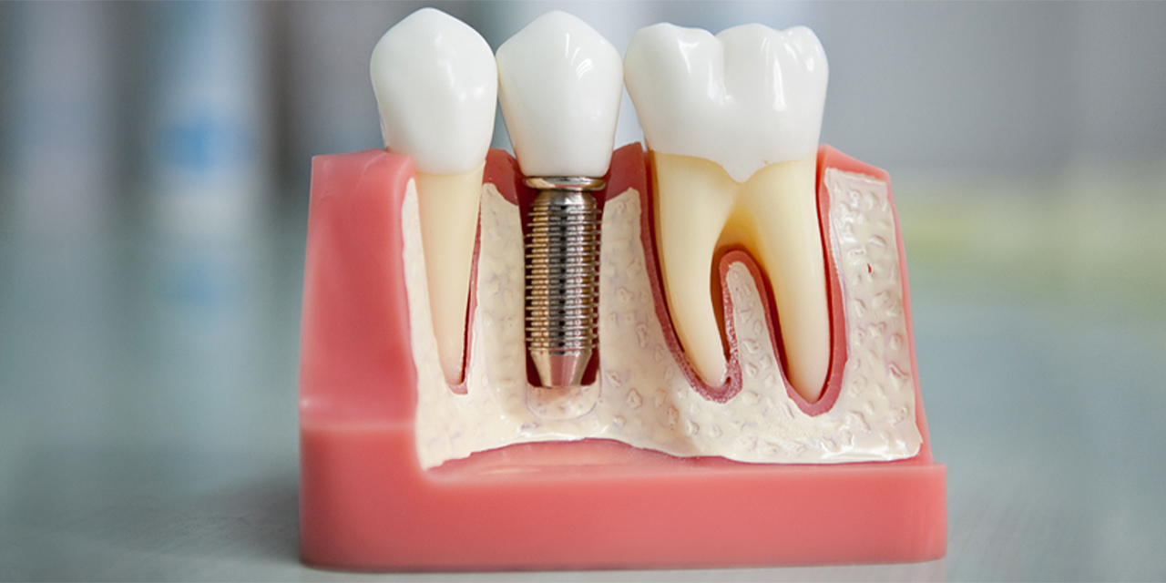 Diş implantı nedir ve nasıl çalışır?