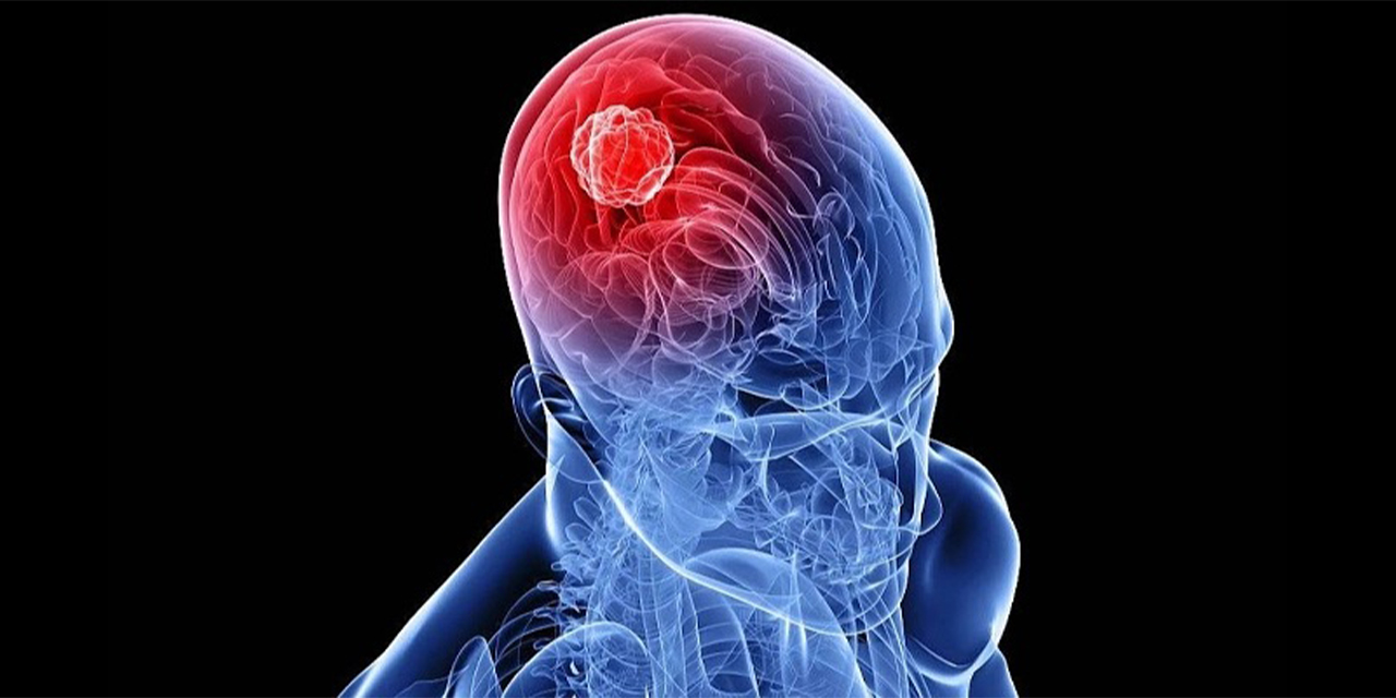 Beyin tümörü ameliyatı nedir ve nasıl yapılır?