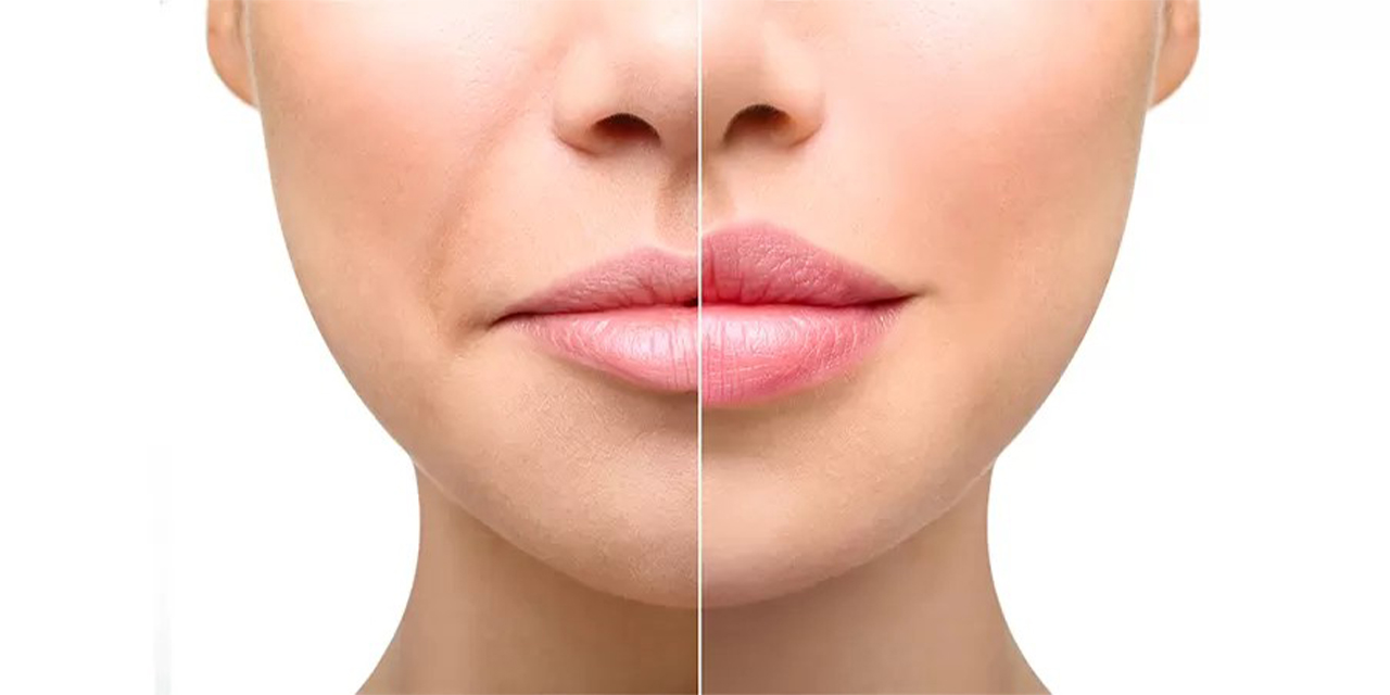 Dudak Dolgusu Nedir? Doğal ve Estetik Bir Görünümün Anahtarı