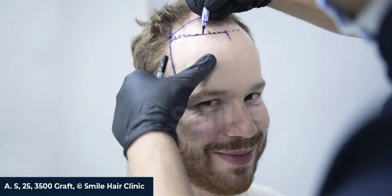 Türkiye’nin En İyi 5 Saç Ekimi Kliniği (2025)