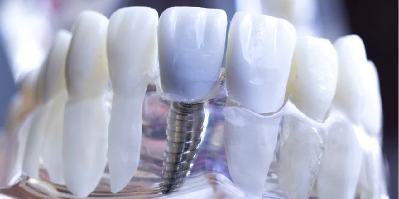 Tek diş eksikliğinde en etkili çözüm: İmplant