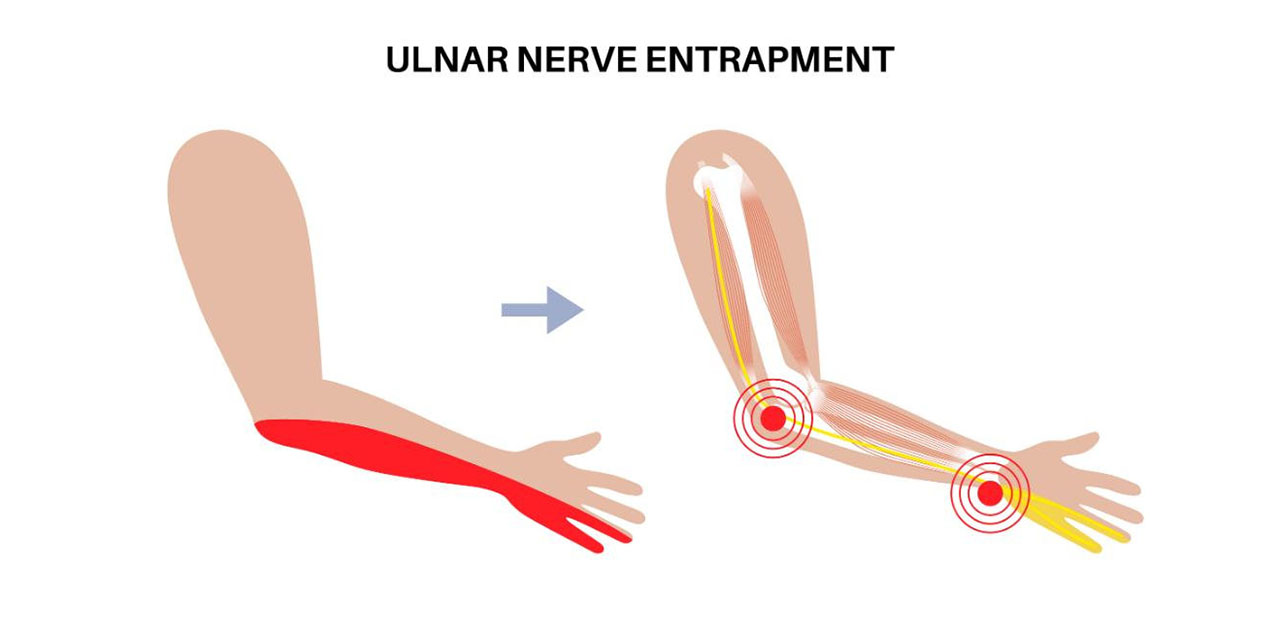 Ulnar Sinir Sıkışması: Serçe Parmağınızdan Gelen Sessiz Uyarı