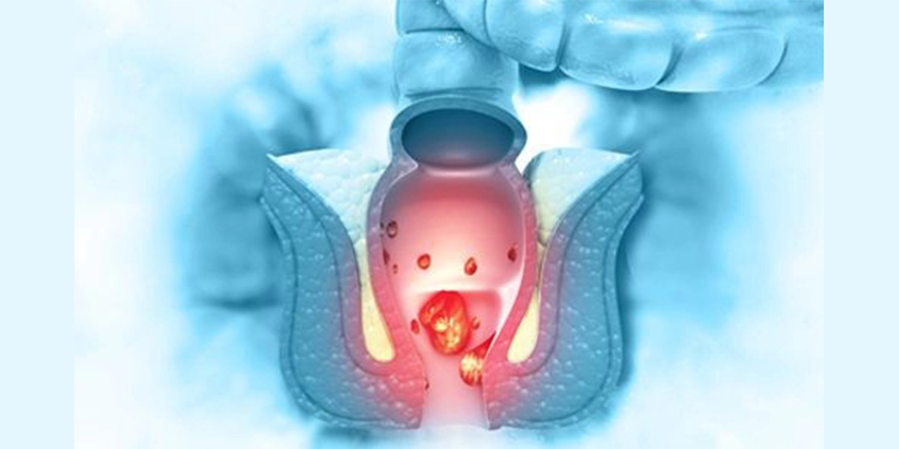 Anal Fissür (Makat Çatlağı): Utanılacak Değil, Tedavi Edilebilir Bir Sorun