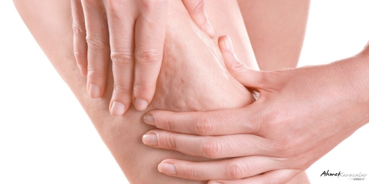 Prof. Dr. Ahmet Karacalar: "Selülit sadece selülit değildir; metabolik bir aynadır"