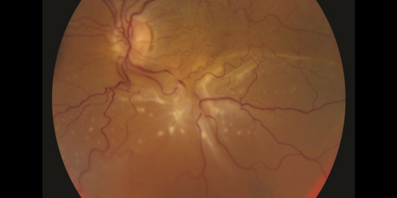 Retina Yırtılması Nedir?