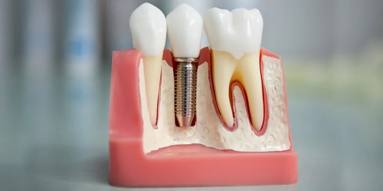 İmplant Nedir? Diş Eksikliğine Kalıcı Çözüm