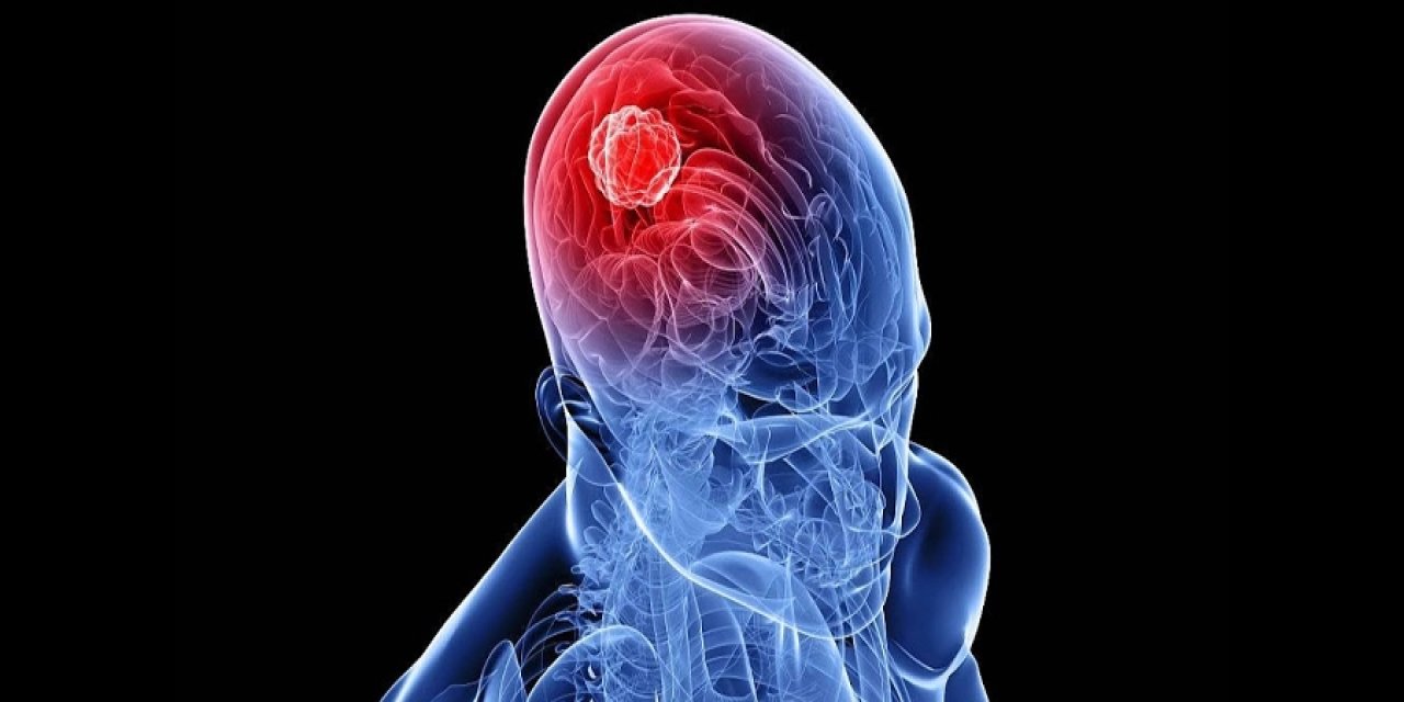 Beyin Tümörü Ameliyatları Nedir?