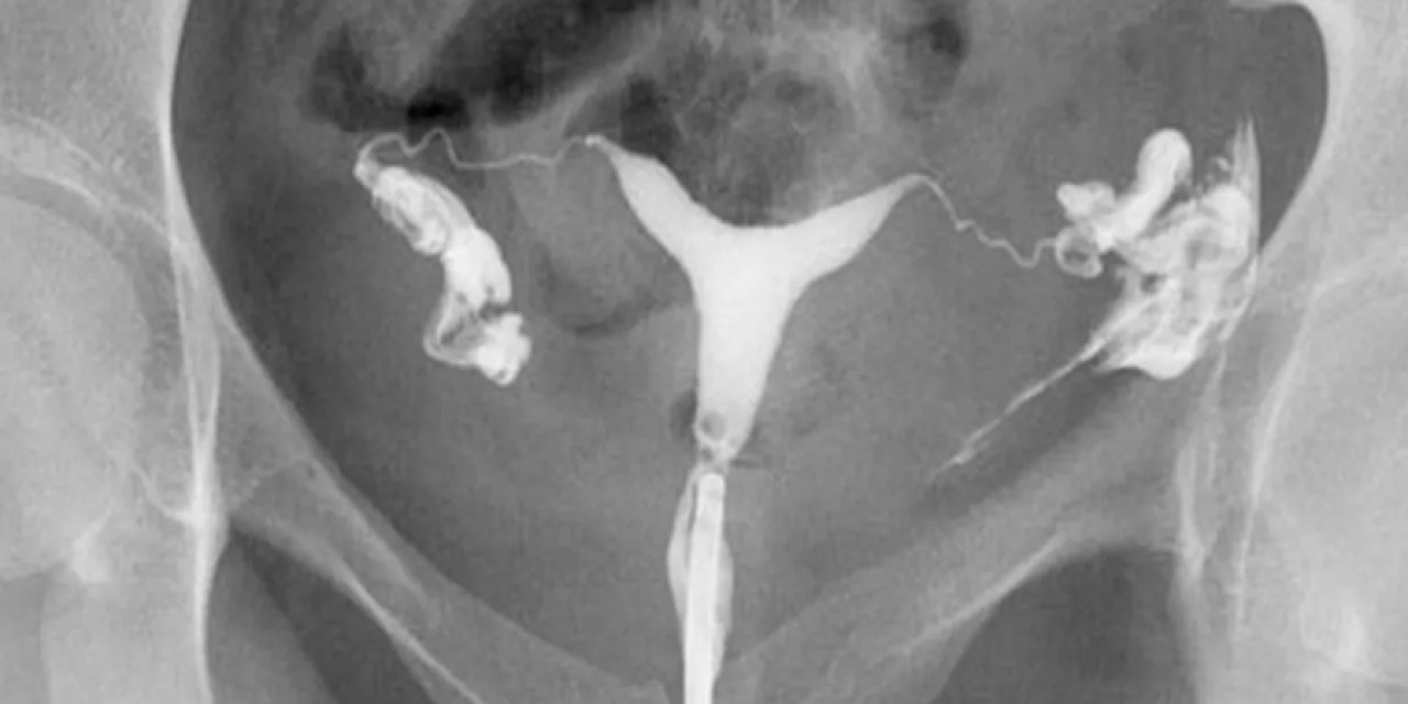 HSG Filmi Nedir? Kadın Üreme Sağlığında Önemi