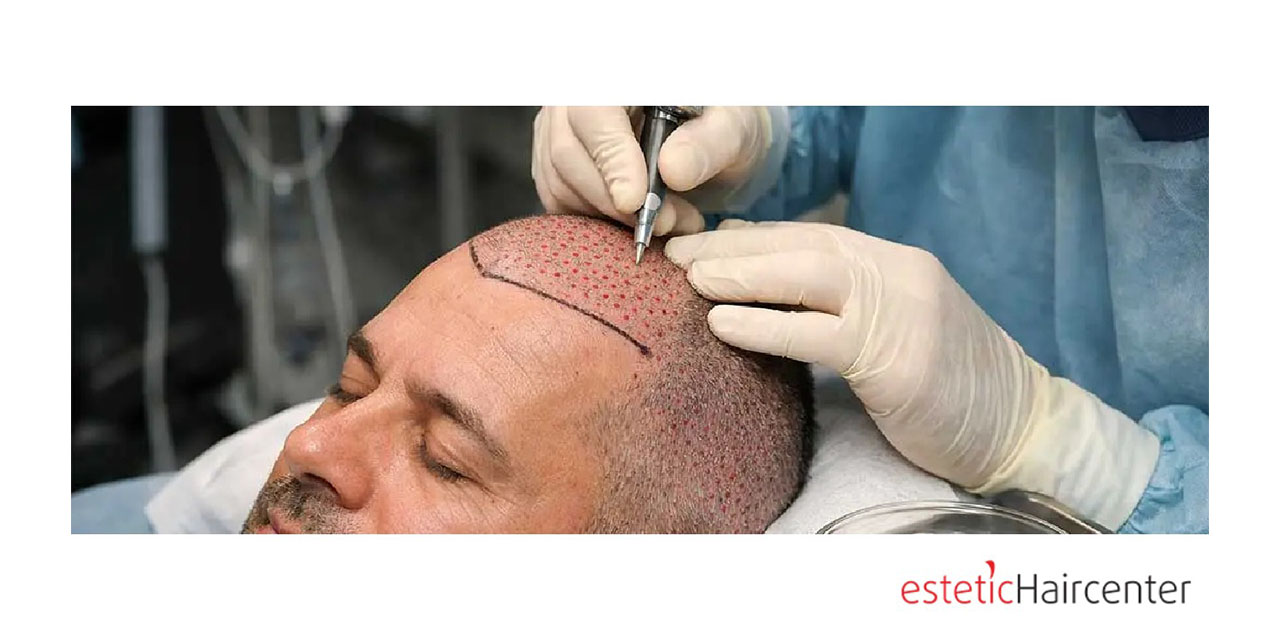 Bursa saç ekimi ile görünüşünüzü yenileyin